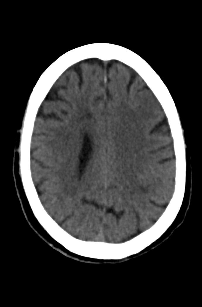 Artery of Percheron infarction (Radiopaedia 80613-94202 Axial non-contrast 129).jpg