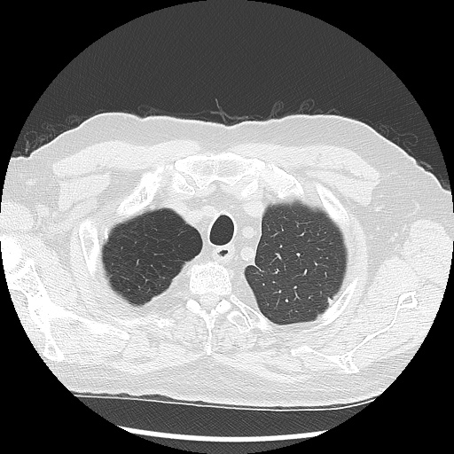 Asbestos-related pleural disease (Radiopaedia 74366-85250 Axial lung window 19).jpg
