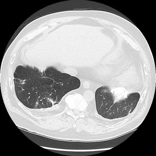 Asbestos-related pleural disease (Radiopaedia 74366-85250 Axial lung window 93).jpg