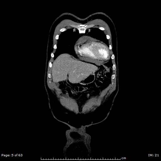 Ascending aortic aneurysm (Radiopaedia 50086-55404 B 5).jpg