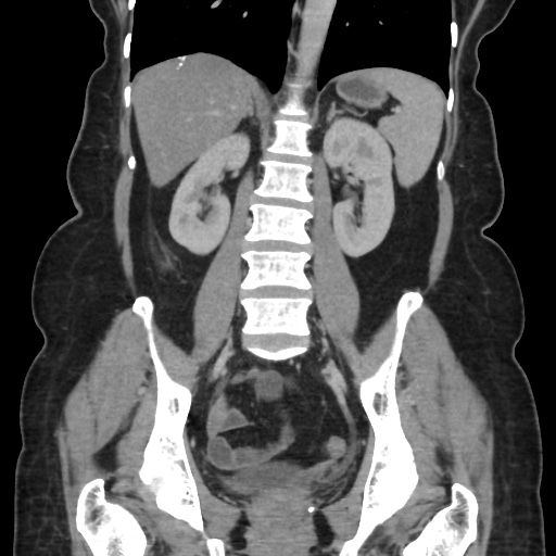 Ascending colon diverticulitis (Radiopaedia 61970-70040 B 40).jpg