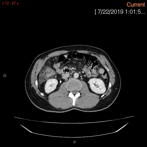 File:Ascending colonic diverticulum mimicking acute appendicitis (Radiopaedia 69943-80198 A 87).jpg