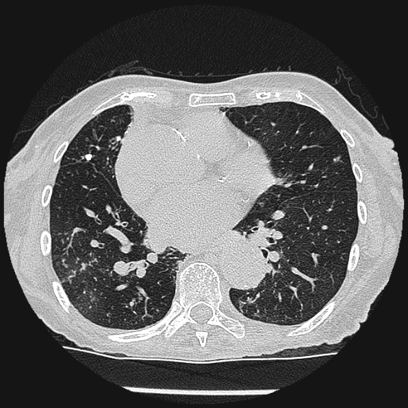 Aspergilloma (Radiopaedia 24458-24763 Axial lung window 41).jpg