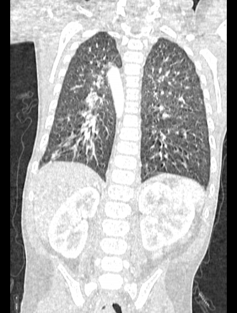Asplenia syndrome (Radiopaedia 73083-83792 Coronal lung window 101).jpg