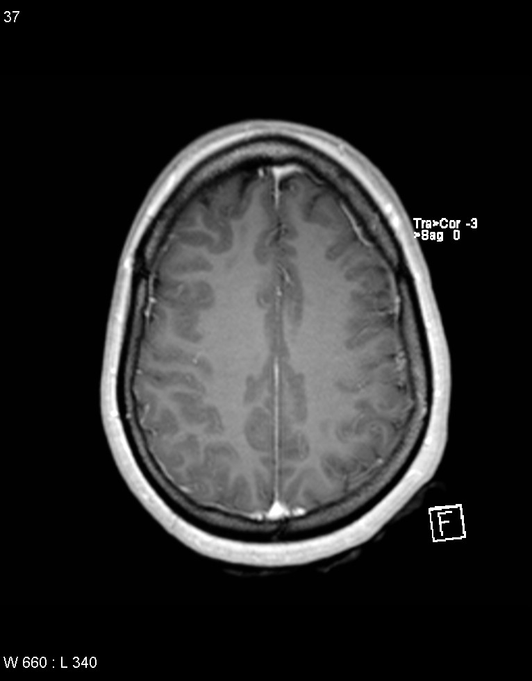 Astroblastoma (Radiopaedia 39792-42218 Axial T1 C+ 36).jpg