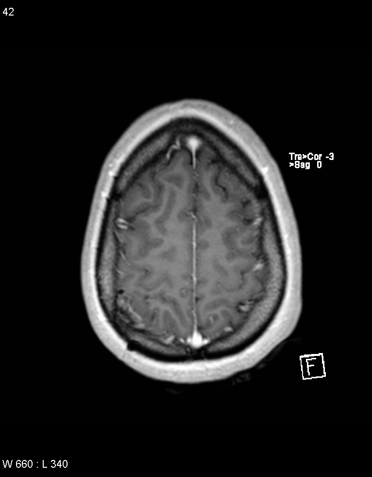 Astroblastoma (Radiopaedia 39792-42218 Axial T1 C+ 41).jpg