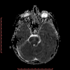 Astroblastoma (Radiopaedia 74287-85162 Axial ADC 16).jpg