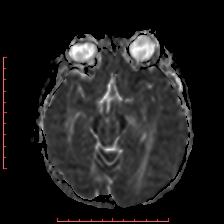 Astroblastoma (Radiopaedia 74287-85162 Axial ADC 23).jpg