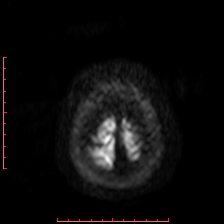 Astroblastoma (Radiopaedia 74287-85162 Axial DWI 109).jpg