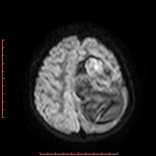Astroblastoma (Radiopaedia 74287-85162 Axial DWI 84).jpg