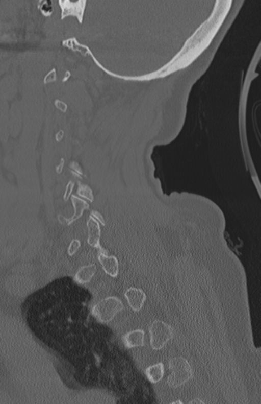 Atlanto-axial subluxation (Radiopaedia 36610-38176 Sagittal bone window 58).png