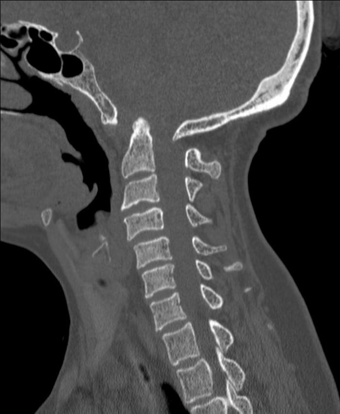 Atlanto-occipital assimilation with basilar invagination (Radiopaedia 70122-80188 Sagittal bone window 50).jpg