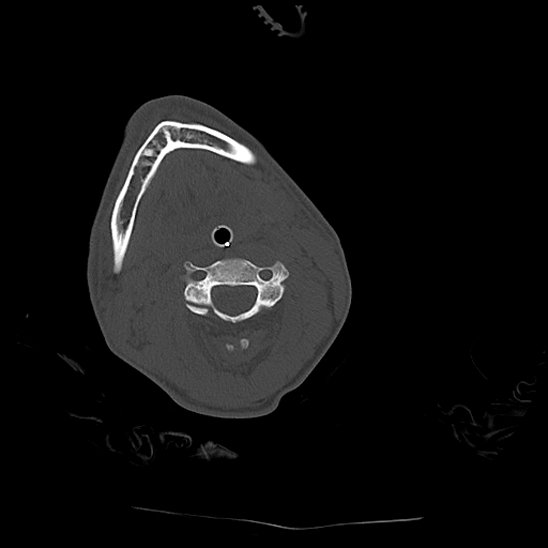 Atlanto-occipital dissociation (Traynelis type 1), C2 teardrop fracture, C6-7 facet joint dislocation (Radiopaedia 87655-104061 Axial bone window 39).jpg