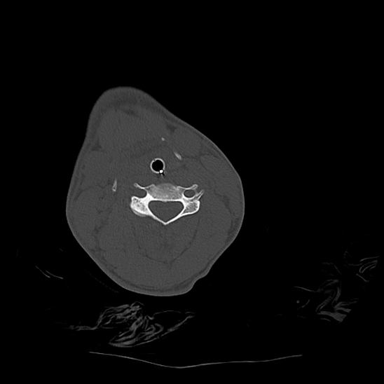 Atlanto-occipital dissociation (Traynelis type 1), C2 teardrop fracture, C6-7 facet joint dislocation (Radiopaedia 87655-104061 Axial bone window 48).jpg