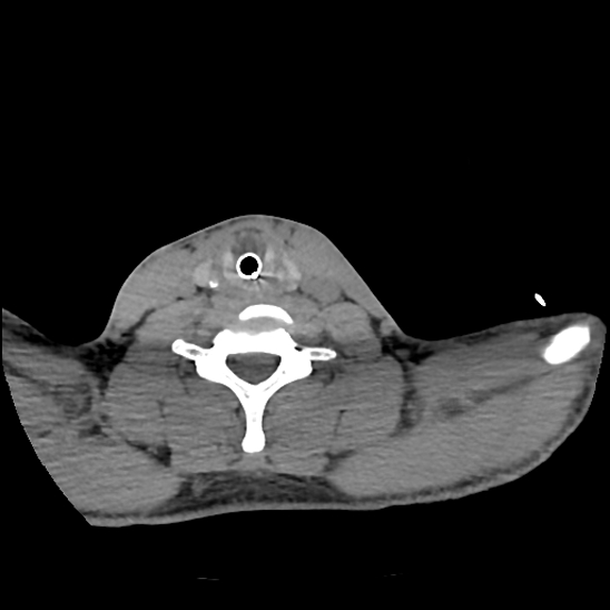 File:Atlanto-occipital dissociation (Traynelis type 1), C2 teardrop fracture, C6-7 facet joint dislocation (Radiopaedia 87655-104061 Axial non-contrast 67).jpg