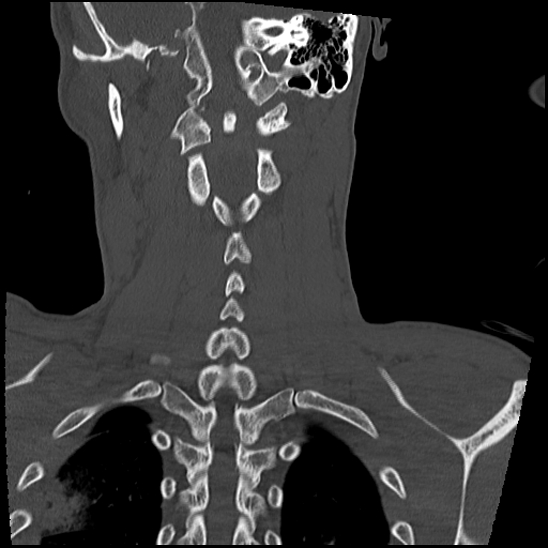 File:Atlanto-occipital dissociation (Traynelis type 1), C2 teardrop fracture, C6-7 facet joint dislocation (Radiopaedia 87655-104061 Coronal bone window 47).jpg
