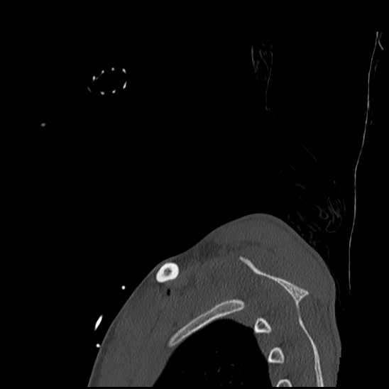 File:Atlanto-occipital dissociation (Traynelis type 1), C2 teardrop fracture, C6-7 facet joint dislocation (Radiopaedia 87655-104061 Sagittal bone window 79).jpg