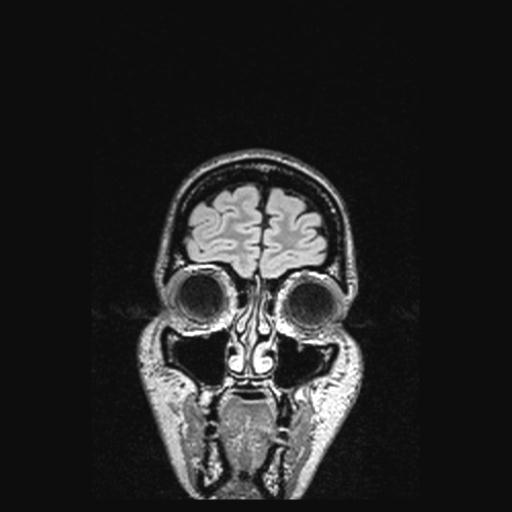 File:Atretic encephalocoele with inferior vermis hypoplasia (Radiopaedia 30443-31108 Coronal FLAIR 162).jpg