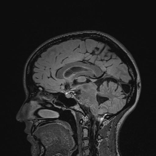Atretic encephalocoele with inferior vermis hypoplasia (Radiopaedia 30443-31108 Sagittal FLAIR 80).jpg