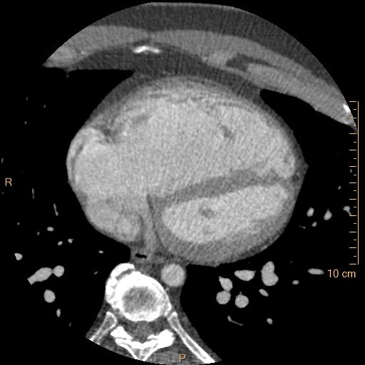 Atrial septal defect (upper sinus venosus type) with partial anomalous pulmonary venous return into superior vena cava (Radiopaedia 73228-83961 A 185).jpg