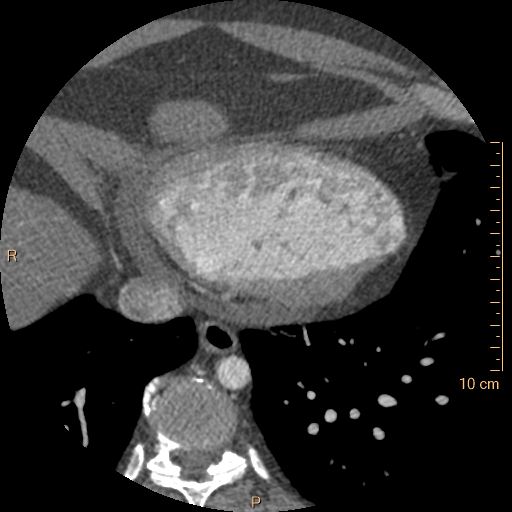 Atrial septal defect (upper sinus venosus type) with partial anomalous pulmonary venous return into superior vena cava (Radiopaedia 73228-83961 A 229).jpg