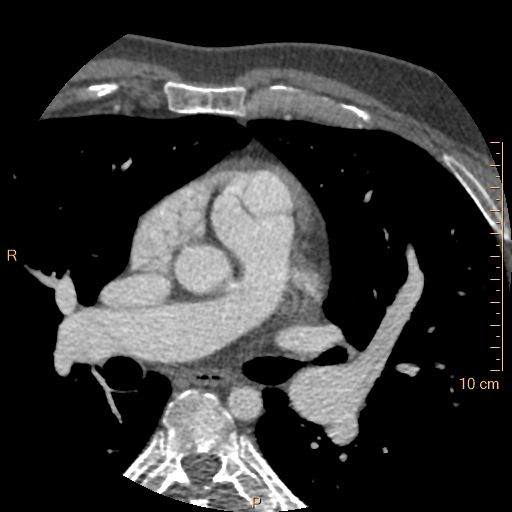 File:Atrial septal defect (upper sinus venosus type) with partial anomalous pulmonary venous return into superior vena cava (Radiopaedia 73228-83961 A 82).jpg