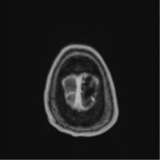 Atypical meningioma (WHO Grade II) (Radiopaedia 54742-60979 Axial T1 C+ 64).png