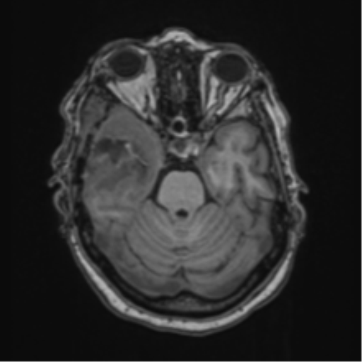 Atypical meningioma (WHO Grade II) (Radiopaedia 54742-60981 Axial T1 22).png