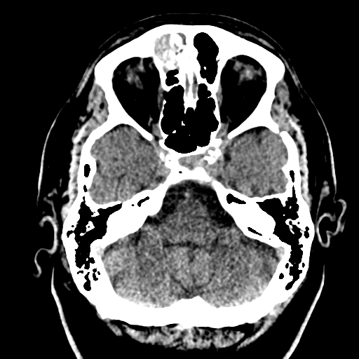 File:Atypical meningioma (WHO grade II) with brain invasion (Radiopaedia 57767-64728 Axial non-contrast 8).png