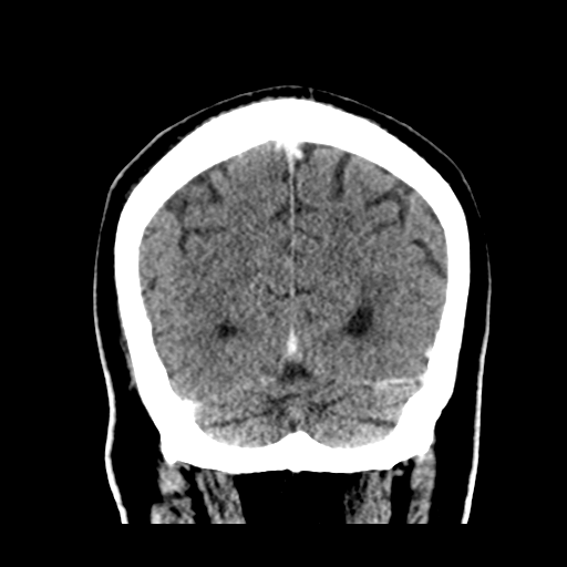 Atypical meningioma (WHO grade II) with brain invasion (Radiopaedia 57767-64728 Coronal C+ 51).png