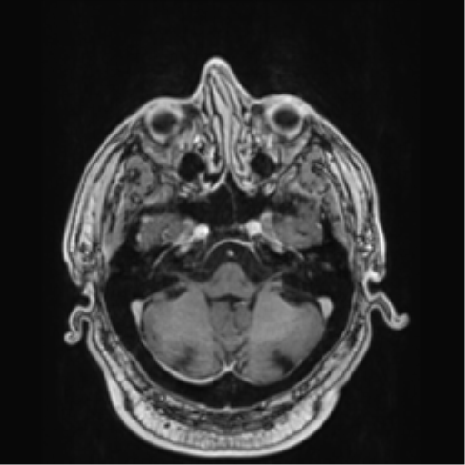 File:Atypical meningioma (WHO grade II) with brain invasion (Radiopaedia 57767-64729 Axial T1 C+ 10).png