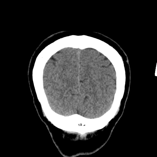 Atypical meningioma (WHO grade II) with osseous invasion (Radiopaedia 53654-59715 Coronal non-contrast 56).png