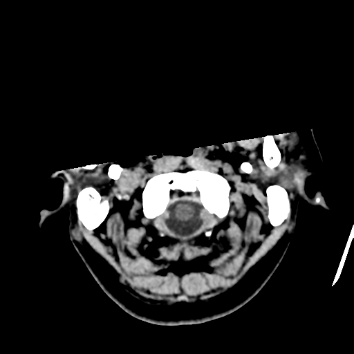 File:Atypical meningioma with skull invasion (Radiopaedia 34357-35649 Axial non-contrast 5).png