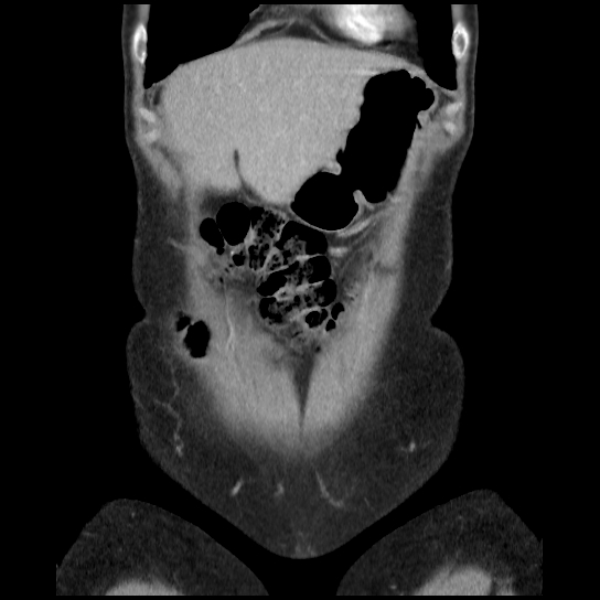 File:Atypical renal cyst (Radiopaedia 17536-17251 C 33).jpg