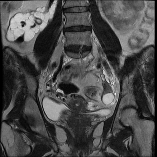 File:Atypical retroperitoneal lymphocoeles with large leiomyoma of uterus (Radiopaedia 32084-33027 Coronal T2 22).jpg