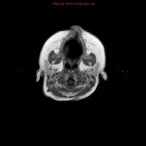 File:Atypical teratoid rhabdoid tumor (Radiopaedia 10712-11183 Axial T1 C+ 18).jpg