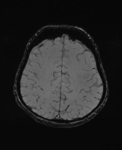 Autoimmune limbic encephalitis (Radiopaedia 30363-31005 SWI - magnitude 58).jpg