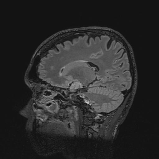 Autoimmune limbic encephalitis (Radiopaedia 30363-31005 Sagittal FLAIR 65).jpg