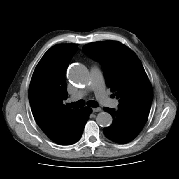 Autosomal dominant polycystic kidney disease (Radiopaedia 27851-28094 Axial non-contrast 23).jpg