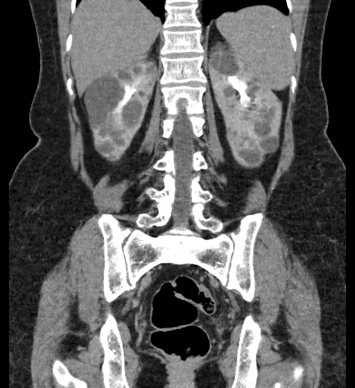 Autosomal dominant polycystic kidney disease (Radiopaedia 38189-40194 Coronal C+ delayed 75).jpg