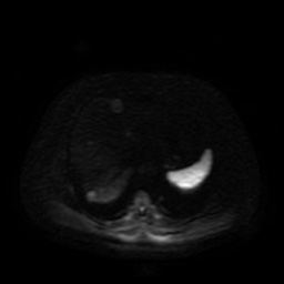 File:Autosomal dominant polycystic kidney disease (Radiopaedia 50259-55611 Axial DWI 78).jpg