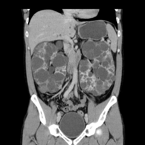 Autosomal dominant polycystic kidney disease (Radiopaedia 66349-75582 A 36).jpg