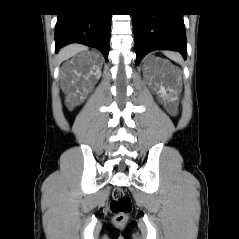 Autosomal dominant polycystic kidney disease (Radiopaedia 66349-75582 A 72).jpg