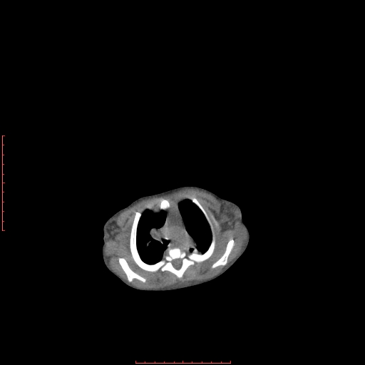 File:Autosomal recessive polycystic kidney disease associated with Caroli disease (Radiopaedia 61932-69984 Axial non-contrast 25).jpg