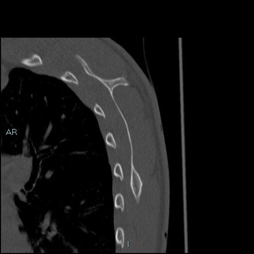 Avascular necrosis after fracture dislocations of the proximal humerus (Radiopaedia 88078-104653 Sagittal bone window 73).jpg