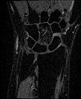Avascular necrosis of the capitate (Radiopaedia 88317-104948 Coronal T1 vibe 35).jpg