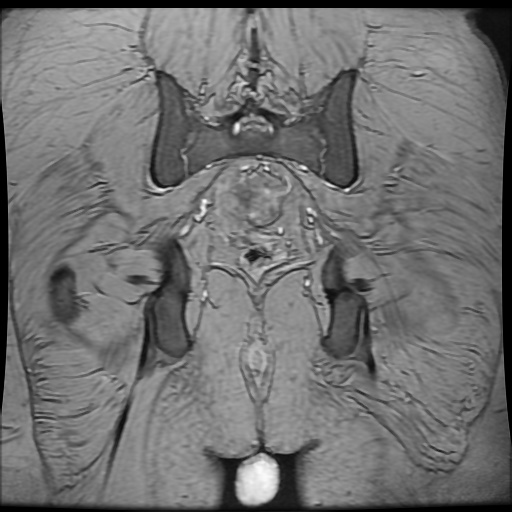 Avascular necrosis of the hip (Radiopaedia 61503-69465 F 86).jpg