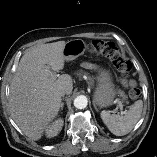 File:Azygos continuation of the inferior vena cava (Radiopaedia 18537-18404 C+ arterial phase 55).jpg