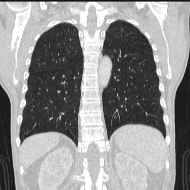 Azygos lobe (Radiopaedia 38259-40275 Coronal lung window 59).jpg