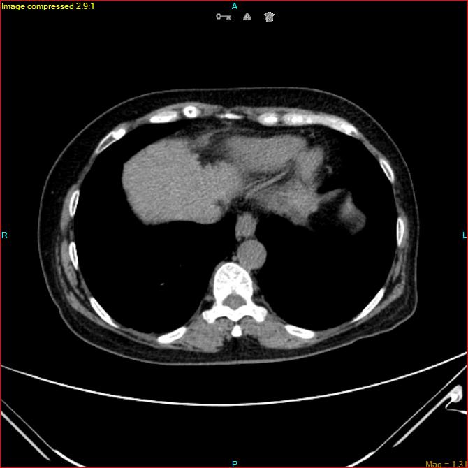 Azygos vein aneurysm (Radiopaedia 77824-90130 A 44).jpg